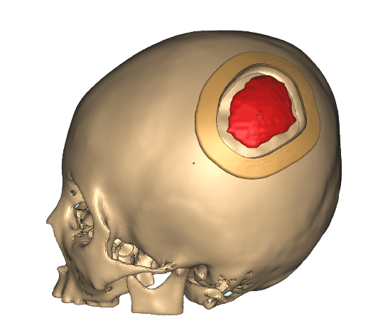 Skull implant protocol