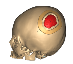 Skull implant protocol Skull implant protocol