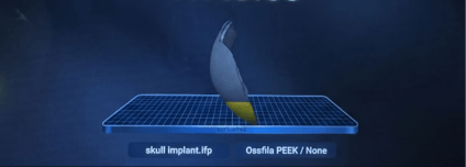 novus Cranial implant printing process